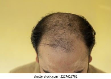 Young Man Hair Fall From Middle Part Of Head