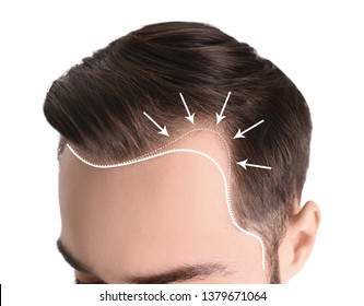 Young Man With Hair Loss Problem On White Background, Closeup