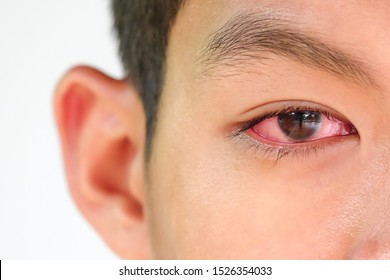 The Young Man Has Red Eye Inflammation,red Eye, Conjunctivitis Or Irritation Of Sensitive Eyes.