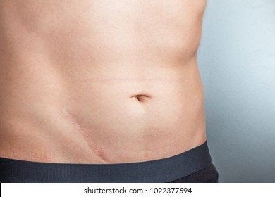 Young man with scar after surgery on abdomen, removal of appendicitis. Scars removal concept.