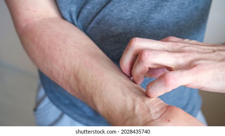 Young Man Scratches Red Irritated Forearm By Hand Suffering From Annoying Skin Itching Standing On Beige Background Extreme Close Crop View