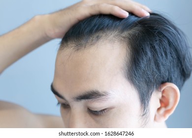 Young Man Serious Hair Loss Problem Stock Photo 1628647246 Shutterstock   Young Man Serious Hair Loss 260nw 1628647246 