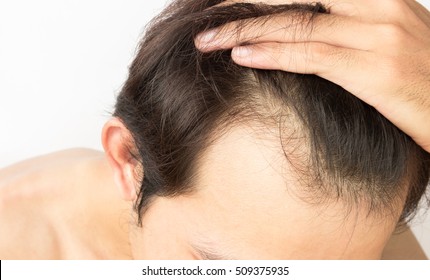 Young Man Serious Hair Loss Problem For Health Care Shampoo And Beauty Product Concept