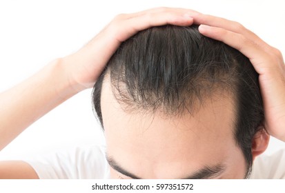 Receding Hairline Images Stock Photos Vectors Shutterstock