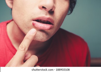 Young Man Is Showing A Cold Sore On His Lip