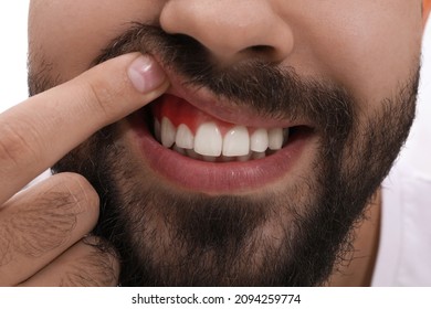 Young Man Showing Inflamed Gums, Closeup View