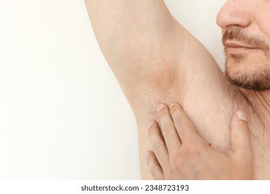 Young man shows irritation on the sensitive skin after using a razor, trimmer, toxic deodorant or antiperspirant. Armpit rash. Allergy, irritation or atopic dermatitis. Acne or red spots underarm