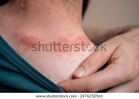 Similar – Image, Stock Photo Psoriasis skin with red wounds. Male arms with cracked, hard, horny, flaky skin. Dermatological problems of allergy, eczema. Hand stains, rash, dry skin. The concept of chronic disease treatment