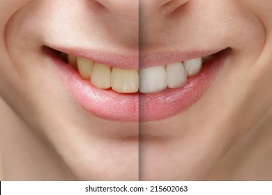 Young Man Smile Before And After Teeth Whitening, Close Up