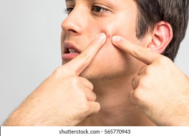 Young Man Squeezing A Pimple, Men's Skincare Concept