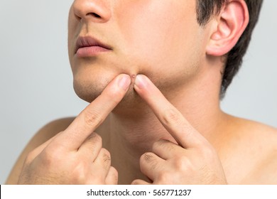 Young Man Squeezing A Pimple, Men's Skincare Concept