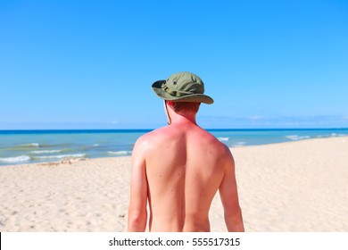 Young Man Standing On The Beach With Sunburned Shoulders