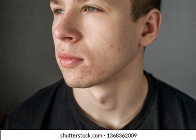 Young Man Struggling With Acne On His Face Caring For His Skin Pushes Acne