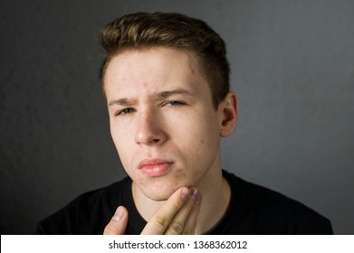 Young Man Struggling With Acne On His Face Caring For His Skin Pushes Acne