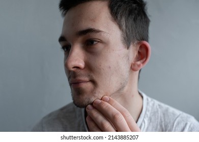 Young Man Struggling With Acne On His Face Caring For His Skin Pushes Acne