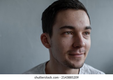 Young Man Struggling With Acne On His Face Caring For His Skin Pushes Acne