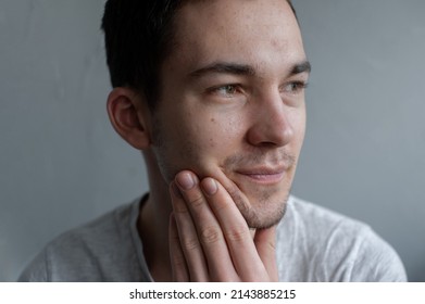 Young Man Struggling With Acne On His Face Caring For His Skin Pushes Acne