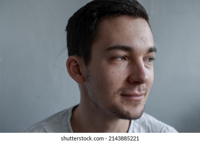 Young Man Struggling With Acne On His Face Caring For His Skin Pushes Acne