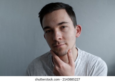 Young Man Struggling With Acne On His Face Caring For His Skin Pushes Acne