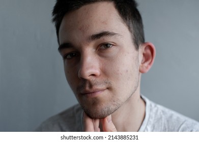 Young Man Struggling With Acne On His Face Caring For His Skin Pushes Acne