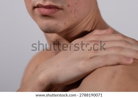  the young man suffers from problematic facial skin as a result of improper metabolism and nutrition, intestinal diseases. Concept: skin problems in teenagers