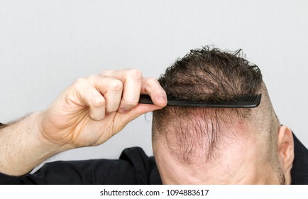 Young Man With Thinning Hair Using Comb Resulting In Losing More Hair