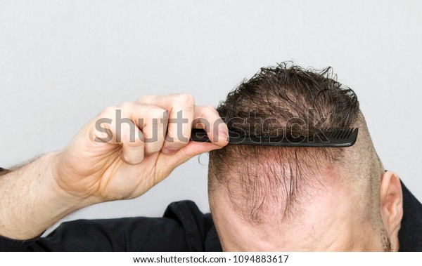 Young Man Thinning Hair Using Comb Stock Image Download Now