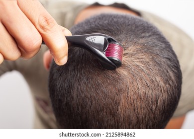 A Young Man Using Dermaroller To Tackle Hair Loss And To Promote Hair Growth On Scalp.