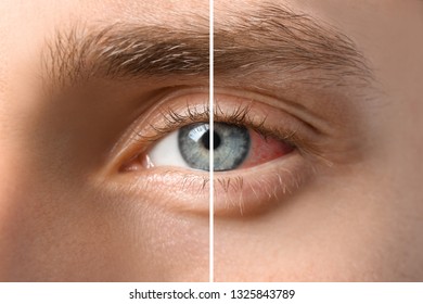 Young man without and with eye redness, closeup