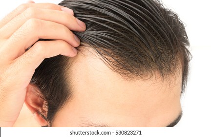 Молодой человек беспокойство проблема выпадения волос для здравоохранения шампунь и концепция продукта красоты