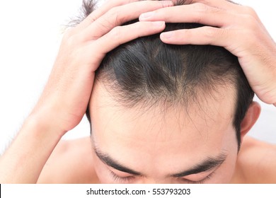 若い男性は、ヘルスケアシャンプーや美容製品のコンセプトに関して、脱毛問題を心配する