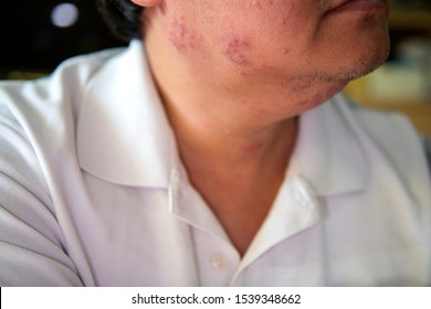 blisters on chin