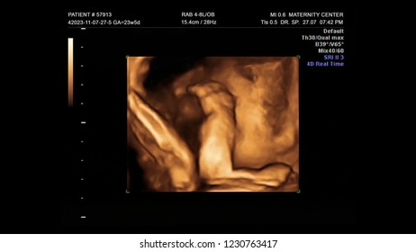 Young Mother Pregnancy Human Baby Embryo Ultrasound 3D 4D, First Child New Life In Maternity Hospital Examination On Display Screen Of Ecography