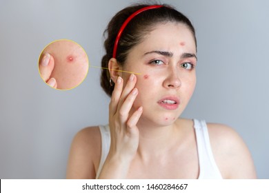 A young pretty brunette looks at her face with pimples. The concept of cosmetology and acne control, adolescence. Enlarged image - Shutterstock ID 1460284667