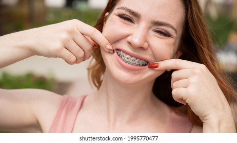 Young Red-haired Woman With Braces On Her Teeth Point To A Smile Outdoors In Summer