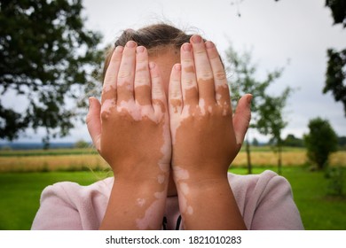 Young Teen Girl Standing Outside And Holding Her Hands In Front Of Her Face To Hide Her Feelings. She Has Skin Condition Called Vitiligo Where It Loses Pigmentation. Conceptual Photo.