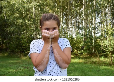 Young Teen Girl Standing Outside And Holding Her Hands In Front Of Her Face To Hide Her Feelings. She Has Skin Condition Called Vitiligo Where It Loses Pigmentation. Conceptual Photo.