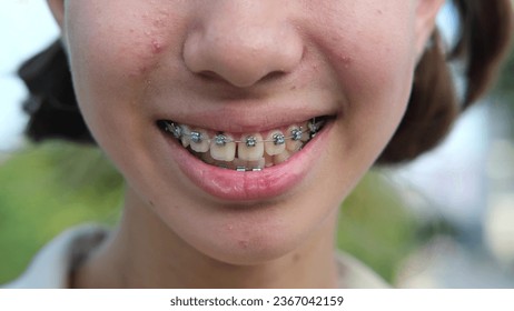 A young teenage girl with braces smiles in nature. Close-up of half of a girl's face - Shutterstock ID 2367042159