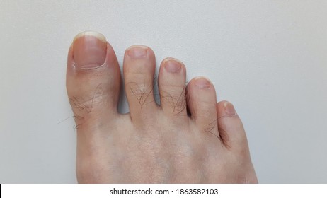 Young White Male Hairy Foot With Uncared Toe Nails 