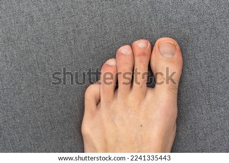 Young white male hairy foot with uncared toe nails
