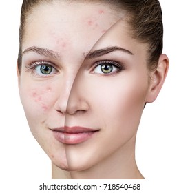 Young Woman With Acne Before And After Treatment.