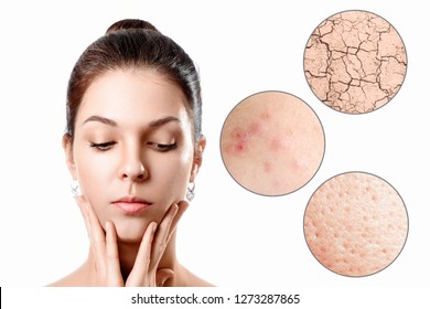 Young Woman With Acne, Dry Skin, Black Dots Skin In Zoom Circle . Skin Care Concept. Young Girl, Beauty Portrait. Close-up.