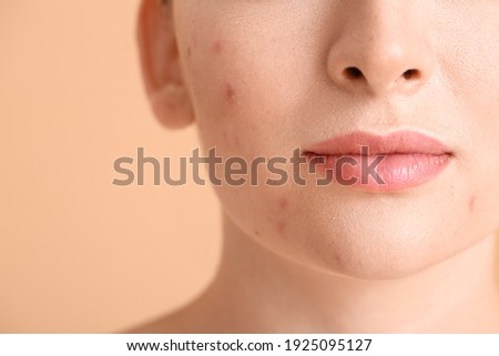 Young woman with acne problem on color background, closeup