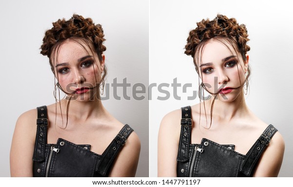 Young woman with acne skin. Before-after\
processing. Woman before and after\
retouch.