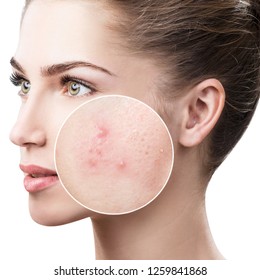 Young Woman With Acne Skin In Zoom Circle. Over White Background.