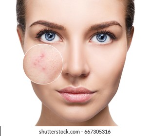 Young Woman With Acne Skin In Zoom Circle.