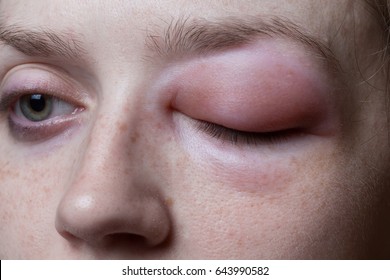 Young Woman With Allergic Reaction