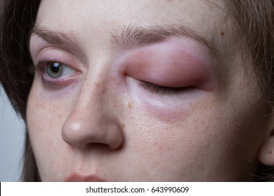 Young Woman With Allergic Reaction - Angioedema