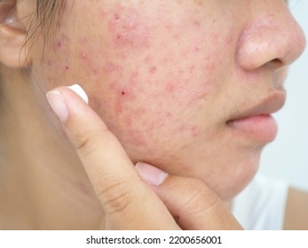 Young Woman Applying Acne Treatment Cream, Closeup Photo, Blurred.