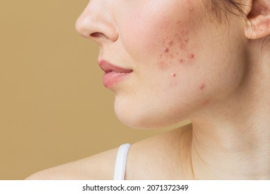 A young woman with bad skin. Skin with a lot of pimples. Acne disease, acne treatment.